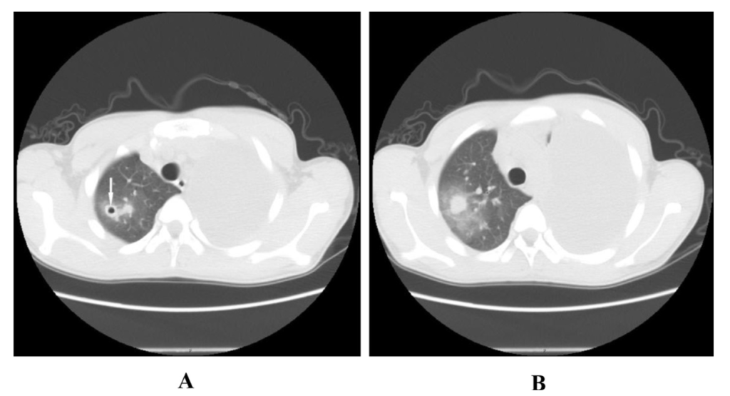 Pleuropulmonary Paragonimiasis