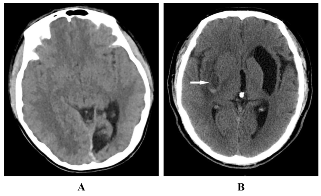 Pleuropulmonary Paragonimiasis