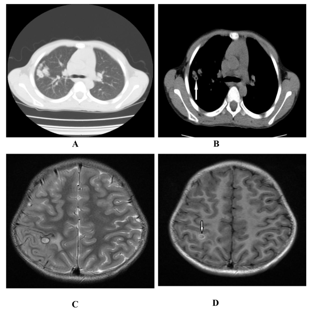 Pleuropulmonary Paragonimiasis brain