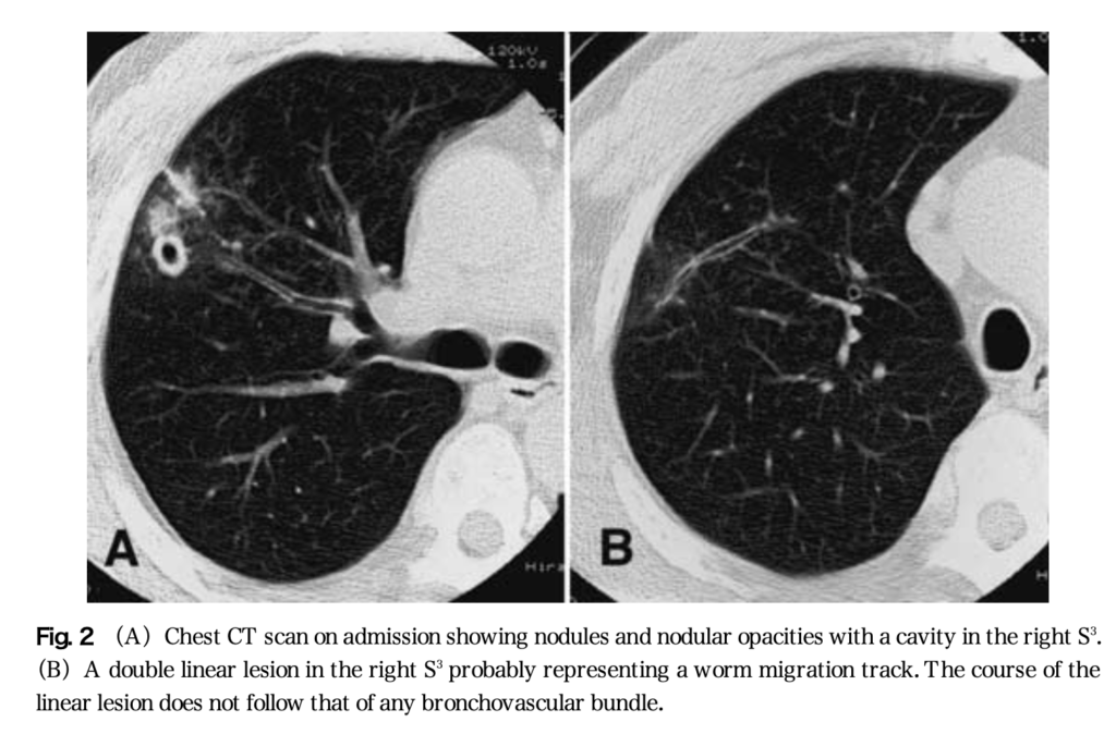 Pleuropulmonary Paragonimiasis worm track