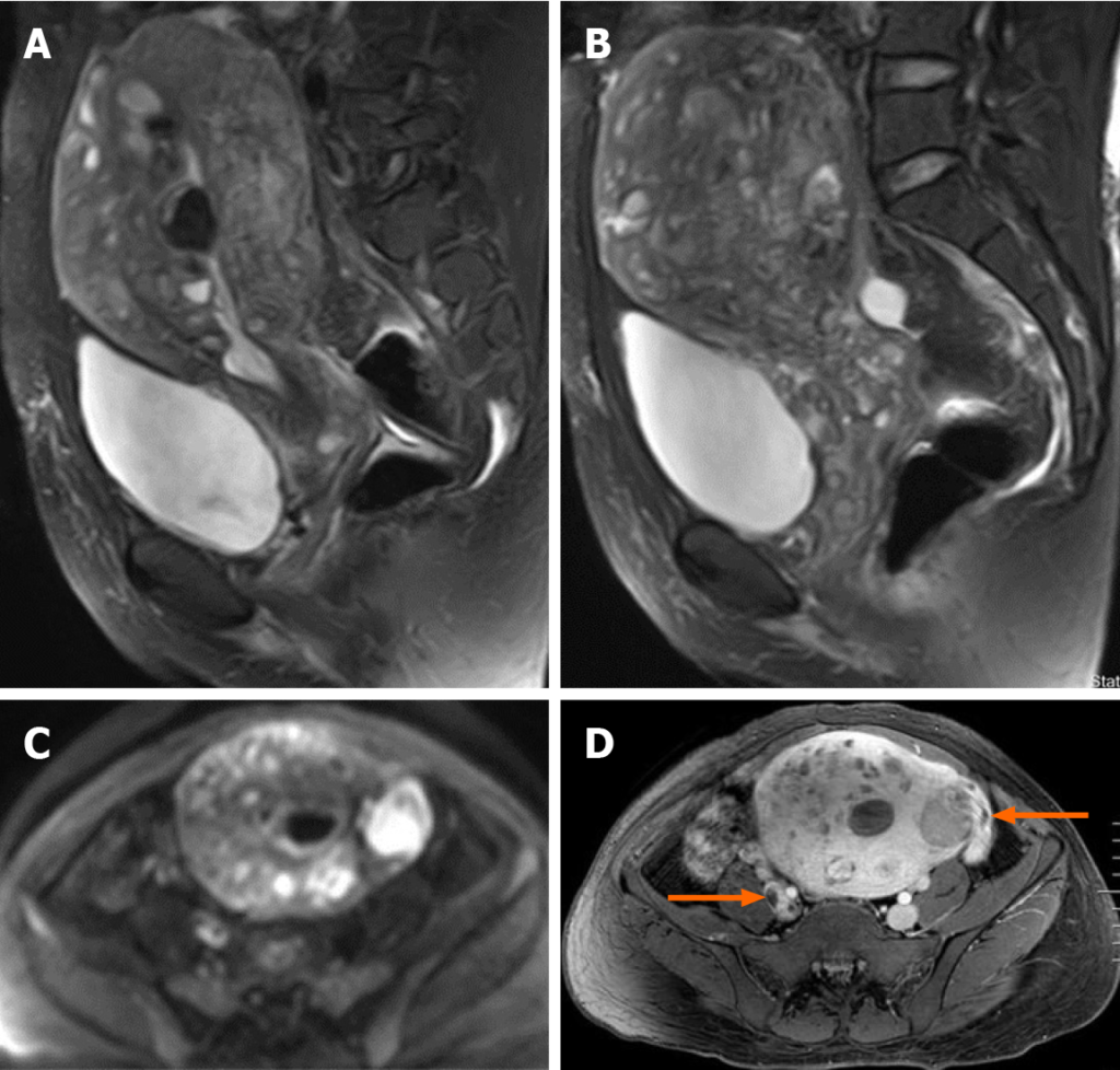 ESS
子宮内膜間質肉腫
endometrial stromal sarcoma
case10