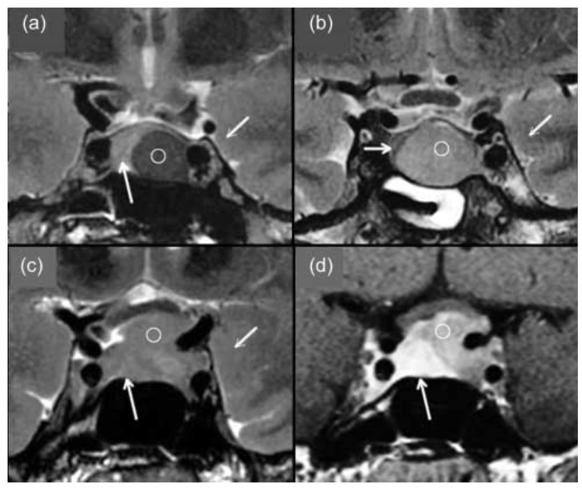 pituitary adenoma/Pitnet growth hormone low T2WI