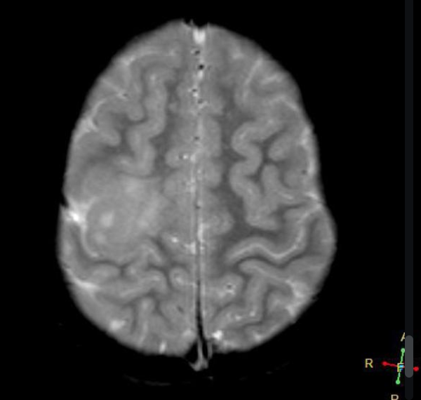 FCD 
focal cortical dysplasia
限局性皮質異形成