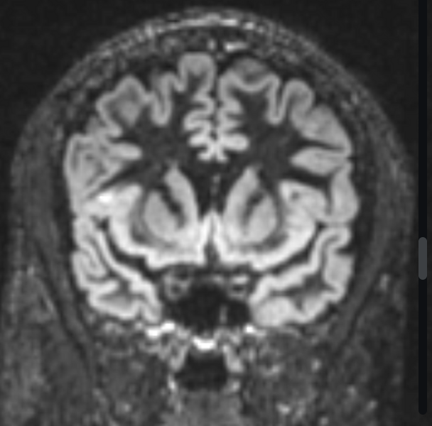 FCD 
focal cortical dysplasia
限局性皮質異形成