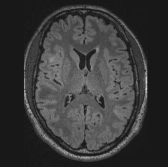 FCD 
focal cortical dysplasia
限局性皮質異形成