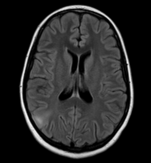 FCD 
focal cortical dysplasia
限局性皮質異形成