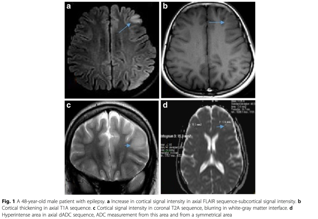 FCD 
focal cortical dysplasia
限局性皮質異形成