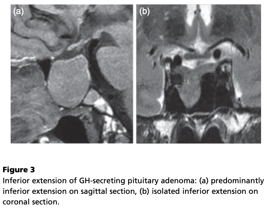 pituitary adenoma/Pitnet growth hormone low T2WI