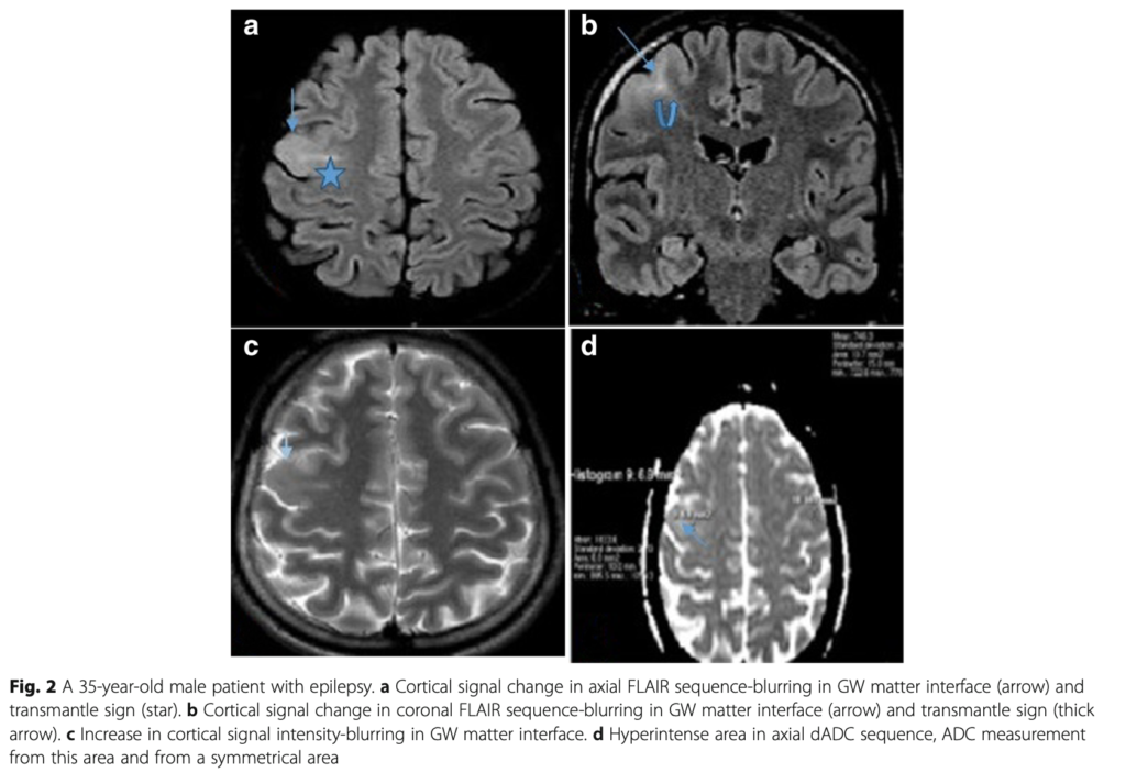 FCD 
focal cortical dysplasia
限局性皮質異形成