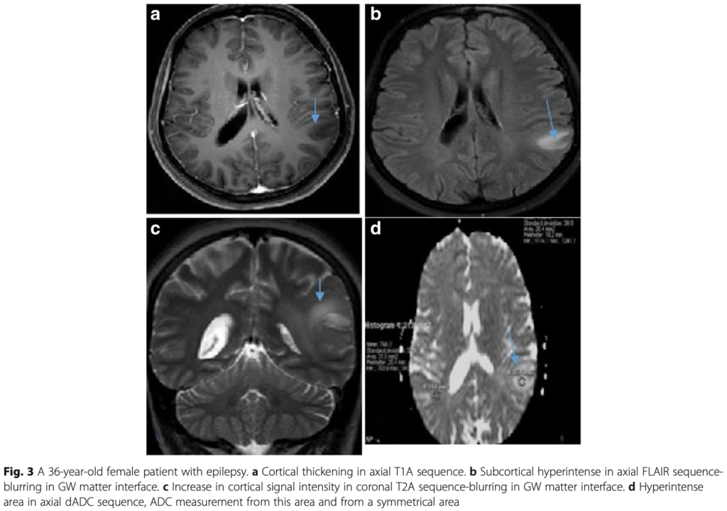 FCD 
focal cortical dysplasia
限局性皮質異形成