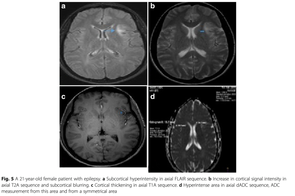 FCD 
focal cortical dysplasia
限局性皮質異形成
case16