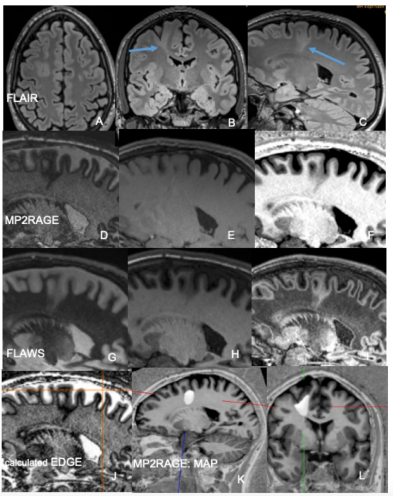 FCD 
focal cortical dysplasia
限局性皮質異形成
case17