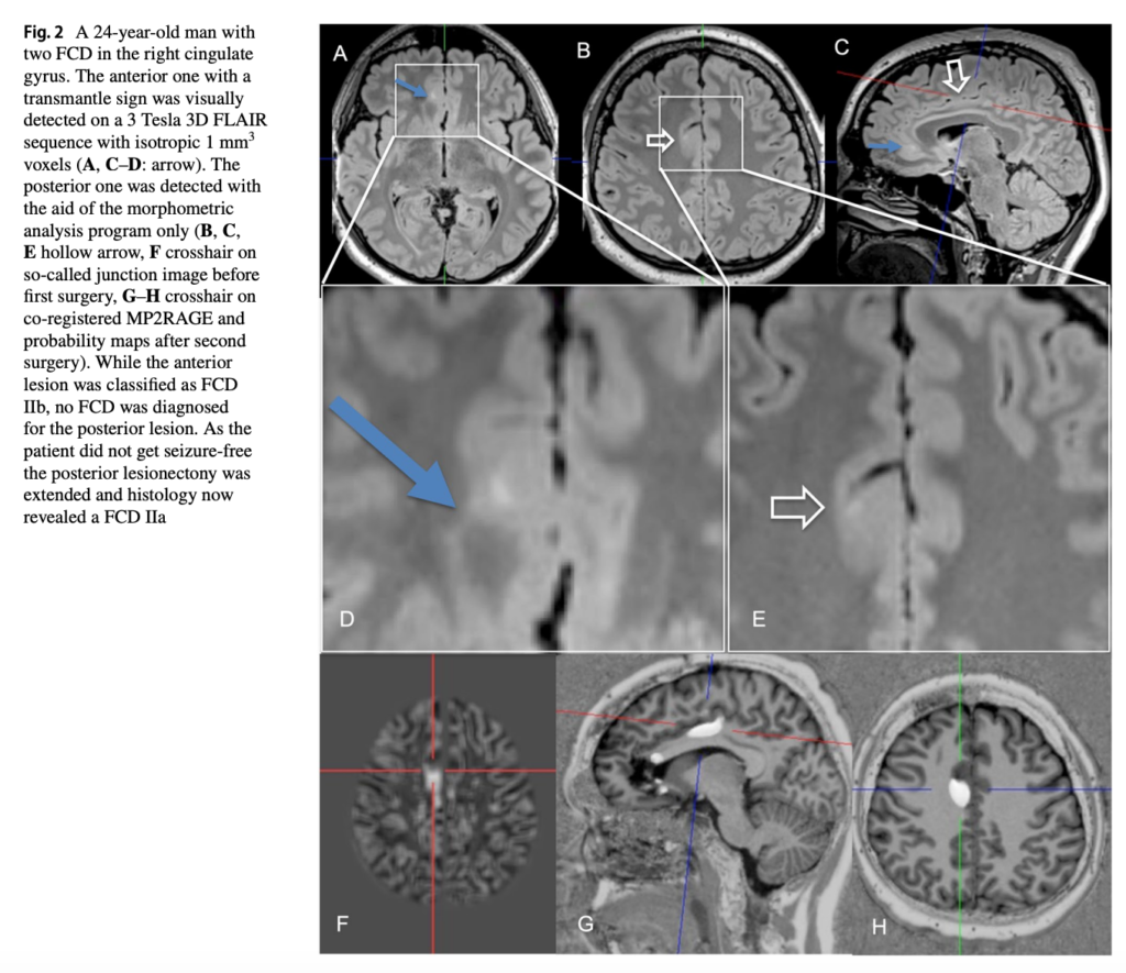 FCD 
focal cortical dysplasia
限局性皮質異形成
case18