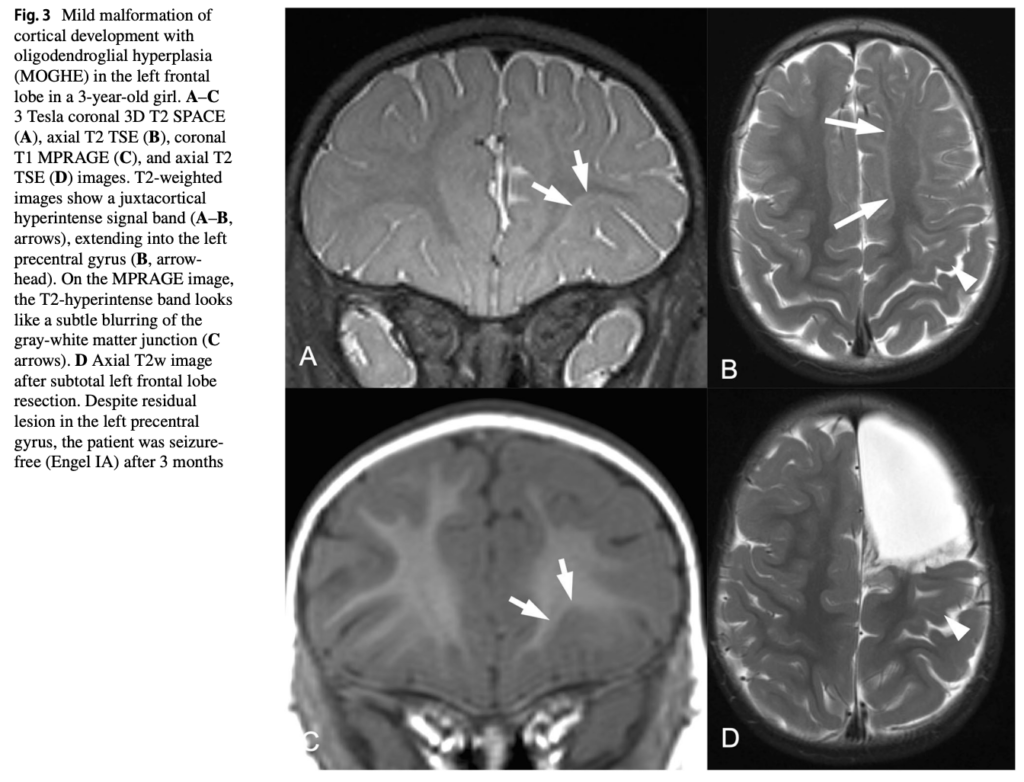 FCD 
focal cortical dysplasia
限局性皮質異形成
case19