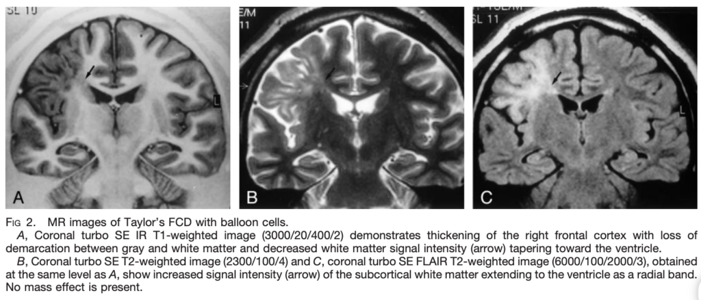 FCD 
focal cortical dysplasia
限局性皮質異形成
case20