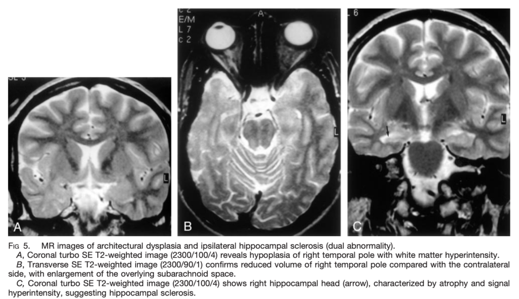 FCD 
focal cortical dysplasia
限局性皮質異形成
case21