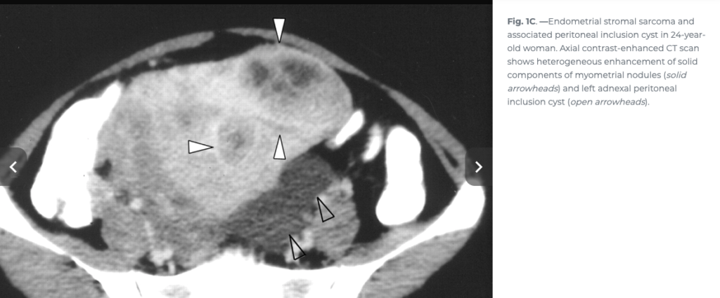 ESS
子宮内膜間質肉腫
endometrial stromal sarcoma
case9