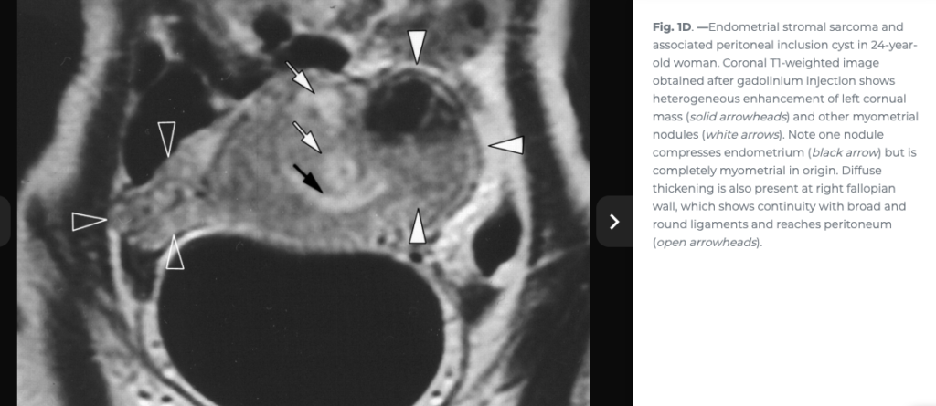 ESS
子宮内膜間質肉腫
endometrial stromal sarcoma
case9