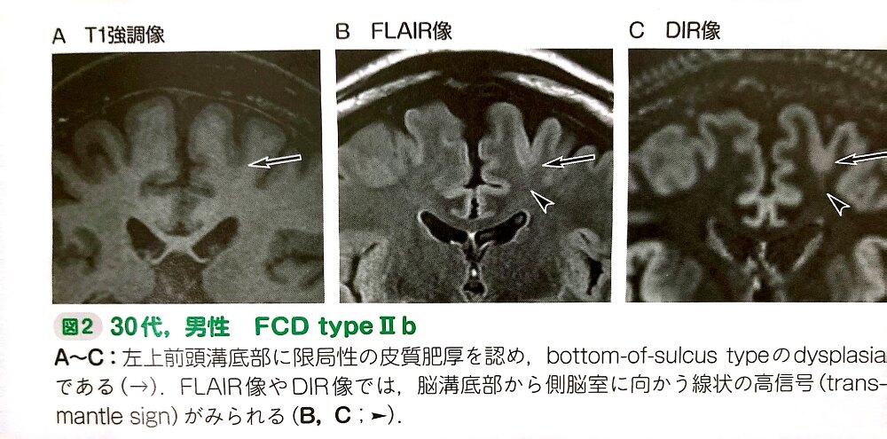 FCD MRI