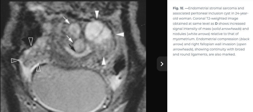 ESS
子宮内膜間質肉腫
endometrial stromal sarcoma
case9
