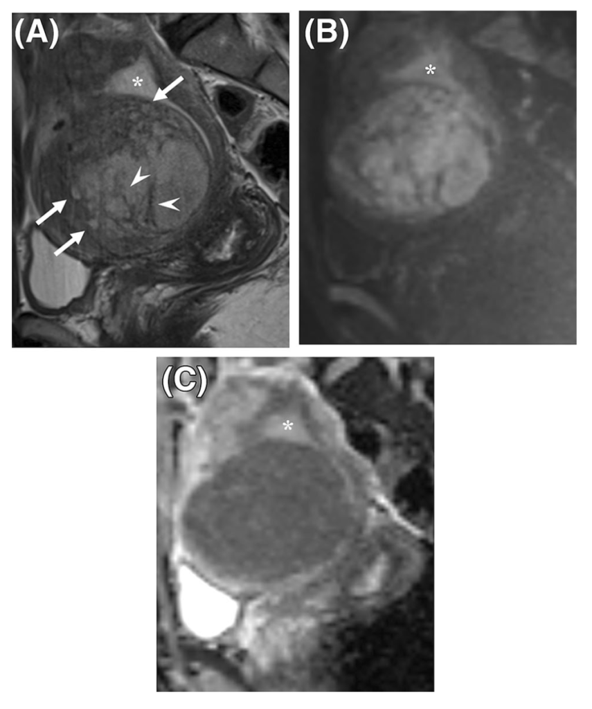 ESS
子宮内膜間質肉腫
endometrial stromal sarcoma
case1