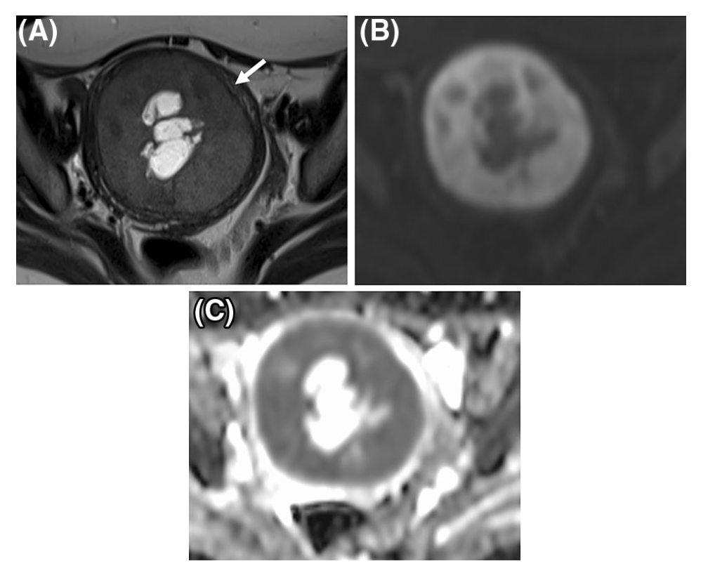 ESS
子宮内膜間質肉腫
endometrial stromal sarcoma
case2