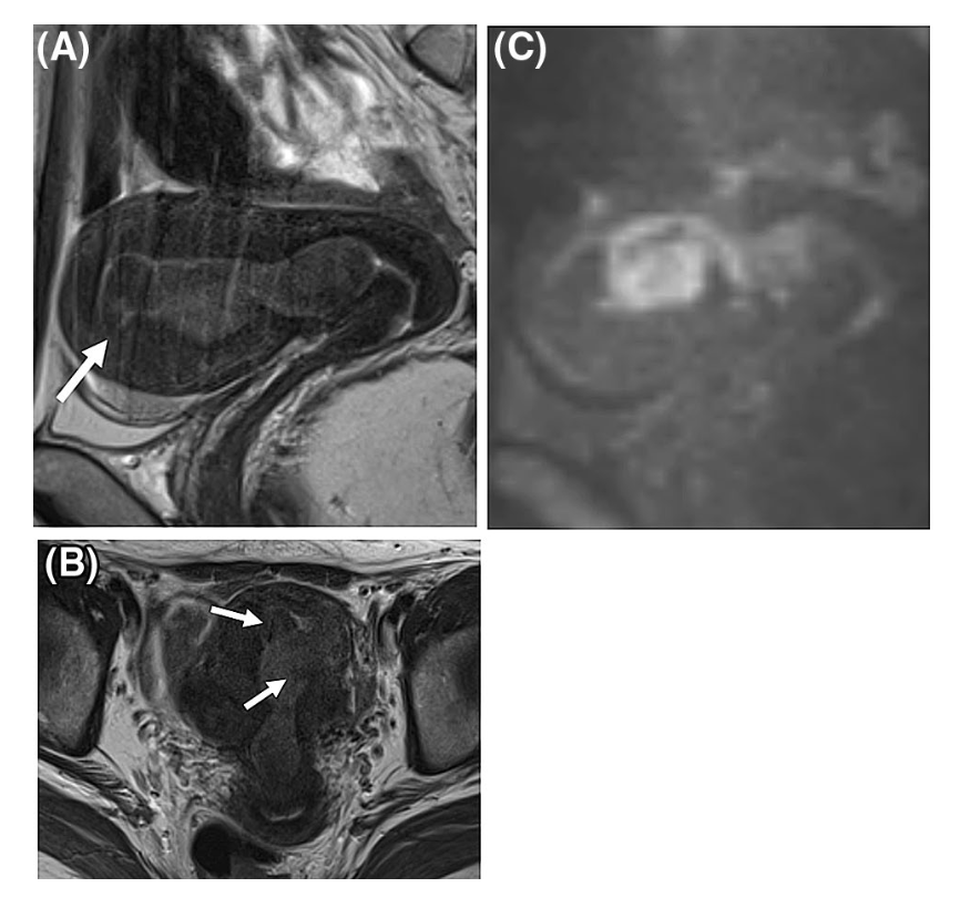 ESS
子宮内膜間質肉腫
endometrial stromal sarcoma
case3