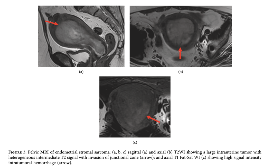 ESS
子宮内膜間質肉腫
endometrial stromal sarcoma
case4