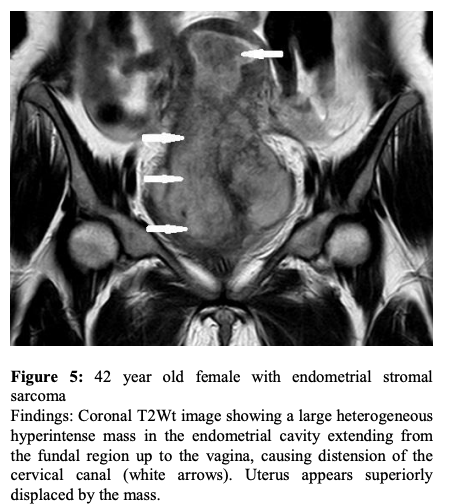 ESS
子宮内膜間質肉腫
endometrial stromal sarcoma
case5