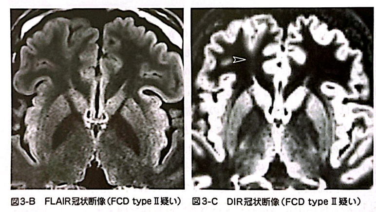 FCD 
focal cortical dysplasia
限局性皮質異形成