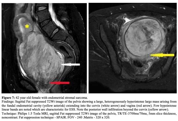 ESS
子宮内膜間質肉腫
endometrial stromal sarcoma
case6