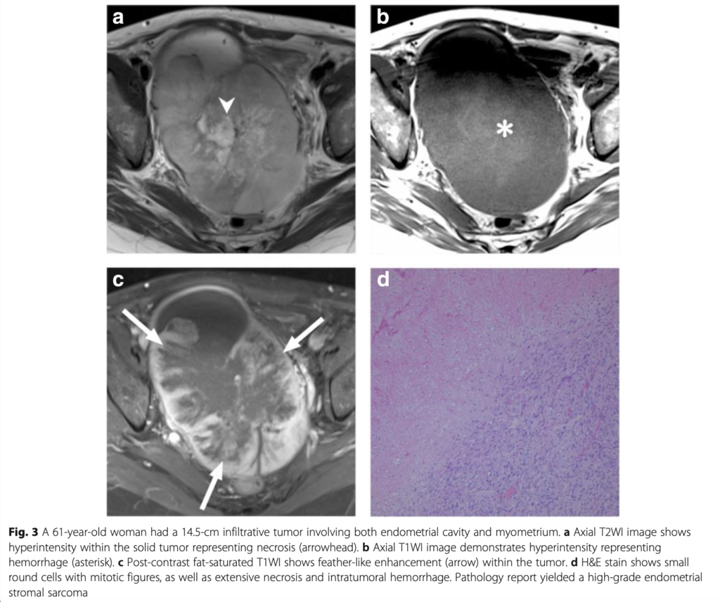 ESS
子宮内膜間質肉腫
endometrial stromal sarcoma
case8