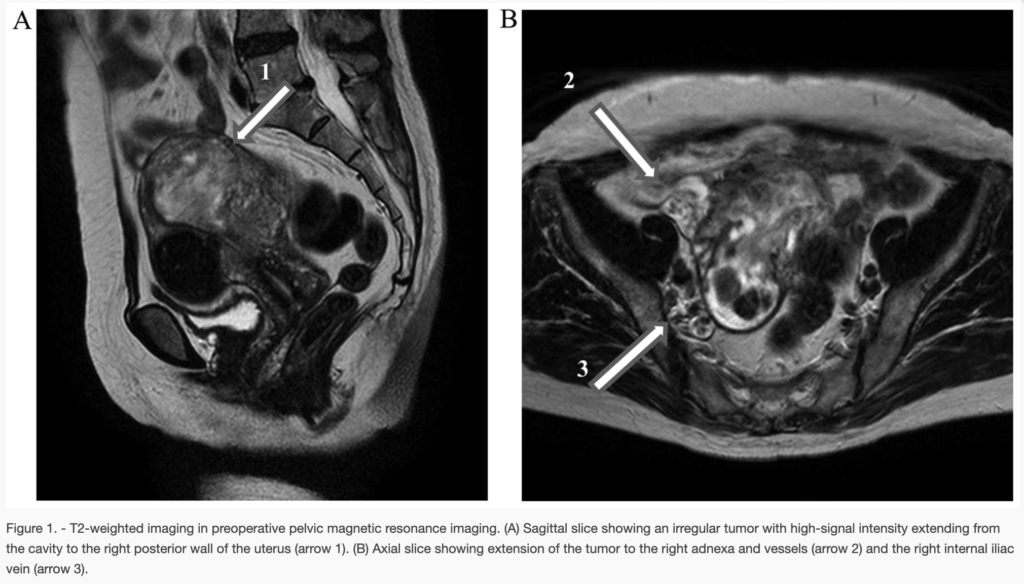 ESS
子宮内膜間質肉腫
endometrial stromal sarcoma
case11