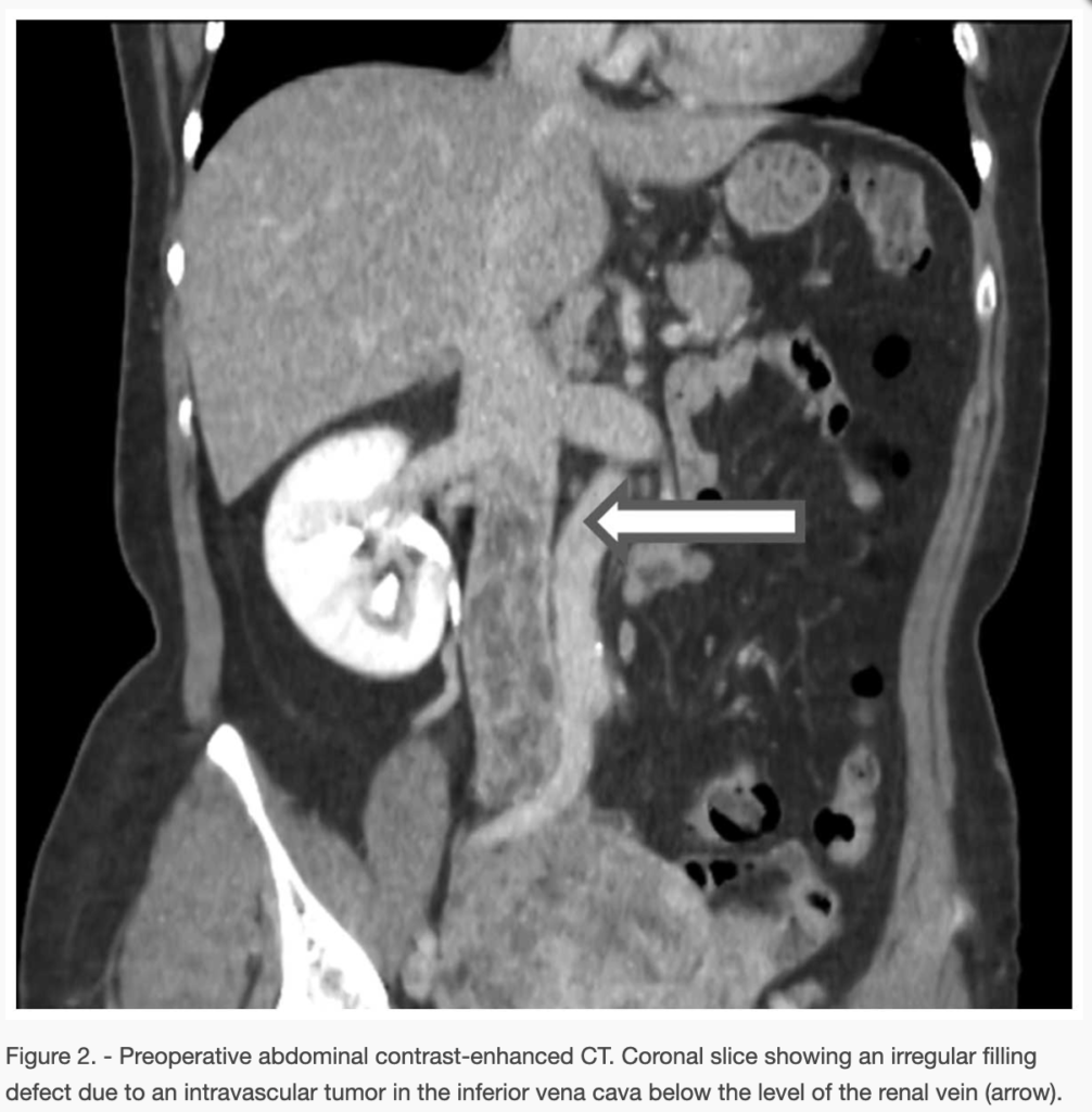 ESS
子宮内膜間質肉腫
endometrial stromal sarcoma
case12