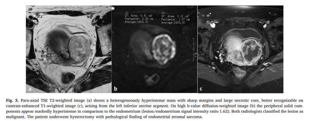 ESS
子宮内膜間質肉腫
endometrial stromal sarcoma
case12