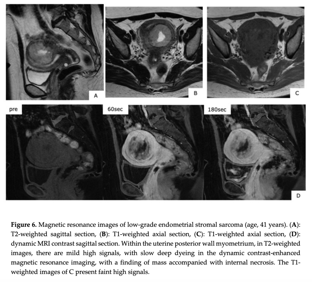 ESS
子宮内膜間質肉腫
endometrial stromal sarcoma
case13