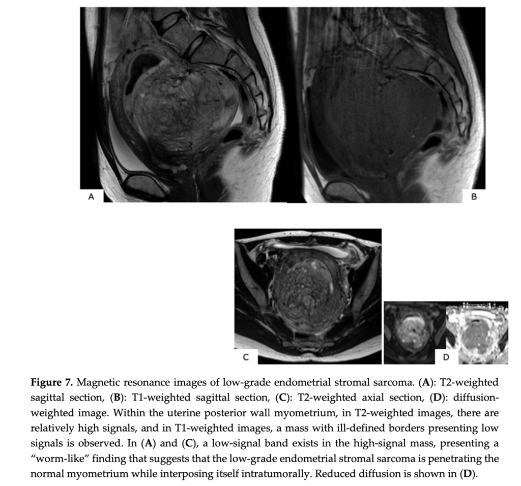 ESS
子宮内膜間質肉腫
endometrial stromal sarcoma
case14