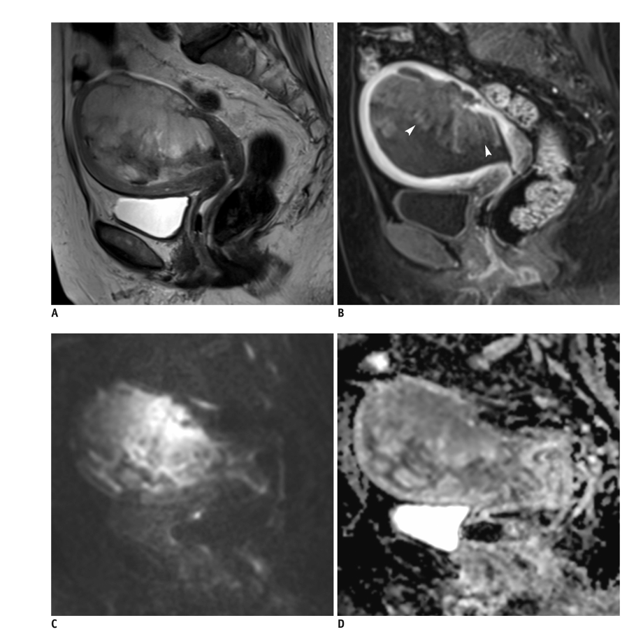 ESS
子宮内膜間質肉腫
endometrial stromal sarcoma
case15