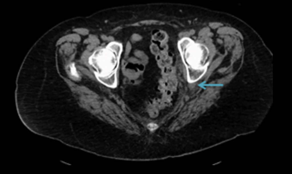 尿管坐骨孔ヘルニア(Ureterosciatic hernia)
case1