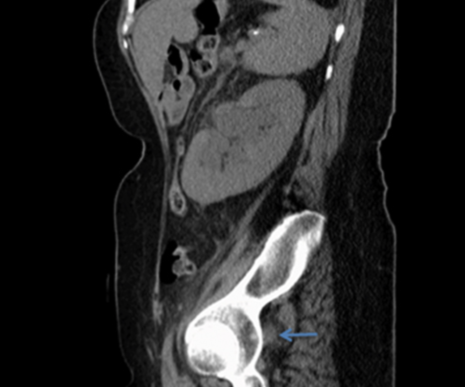 尿管坐骨孔ヘルニア(Ureterosciatic hernia)
case1