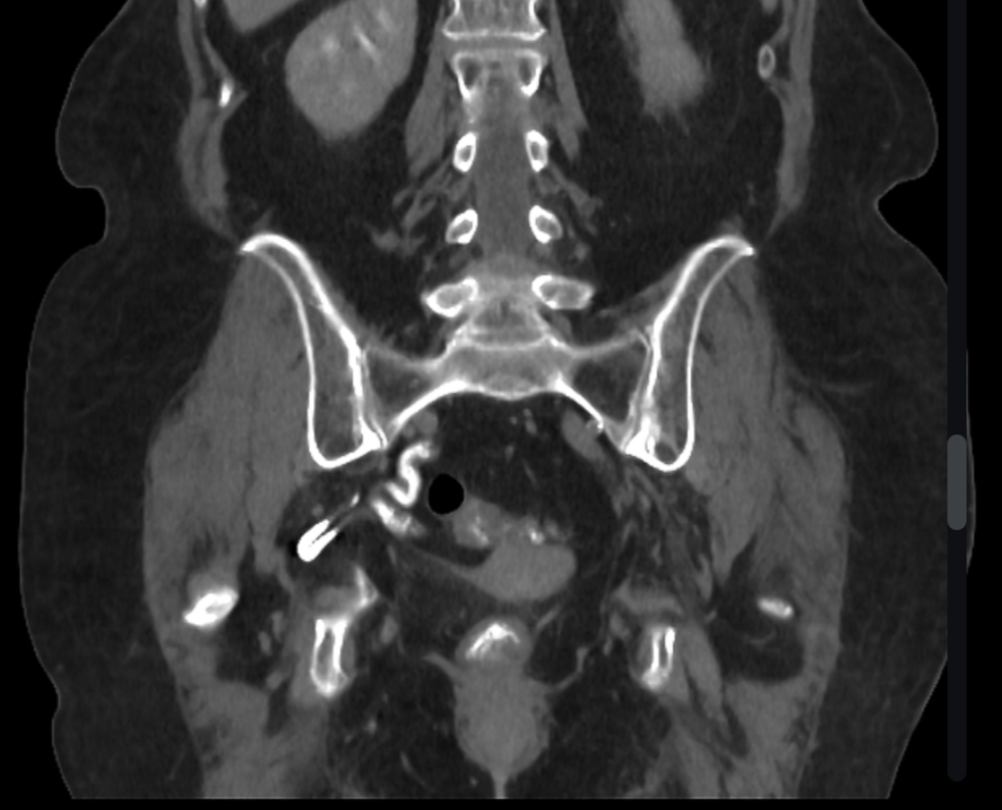 尿管坐骨孔ヘルニア(Ureterosciatic hernia)
case2