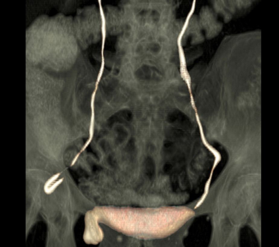 尿管坐骨孔ヘルニア(Ureterosciatic hernia)
case1