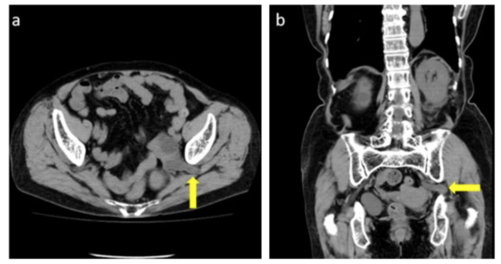 尿管坐骨孔ヘルニア(Ureterosciatic hernia)
case3