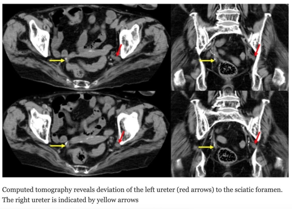 尿管坐骨孔ヘルニア(Ureterosciatic hernia)
case4