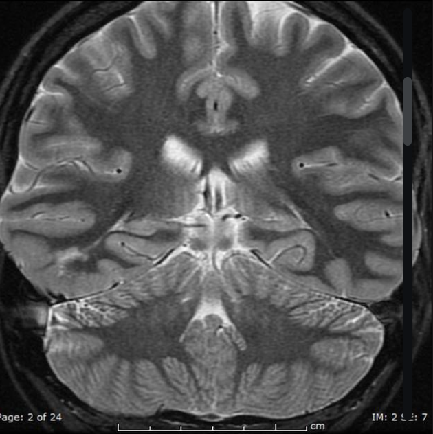 FCD 
focal cortical dysplasia
限局性皮質異形成