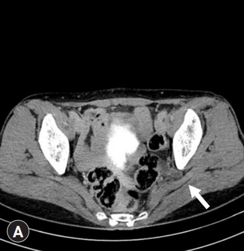 尿管坐骨孔ヘルニア(Ureterosciatic hernia)
case5