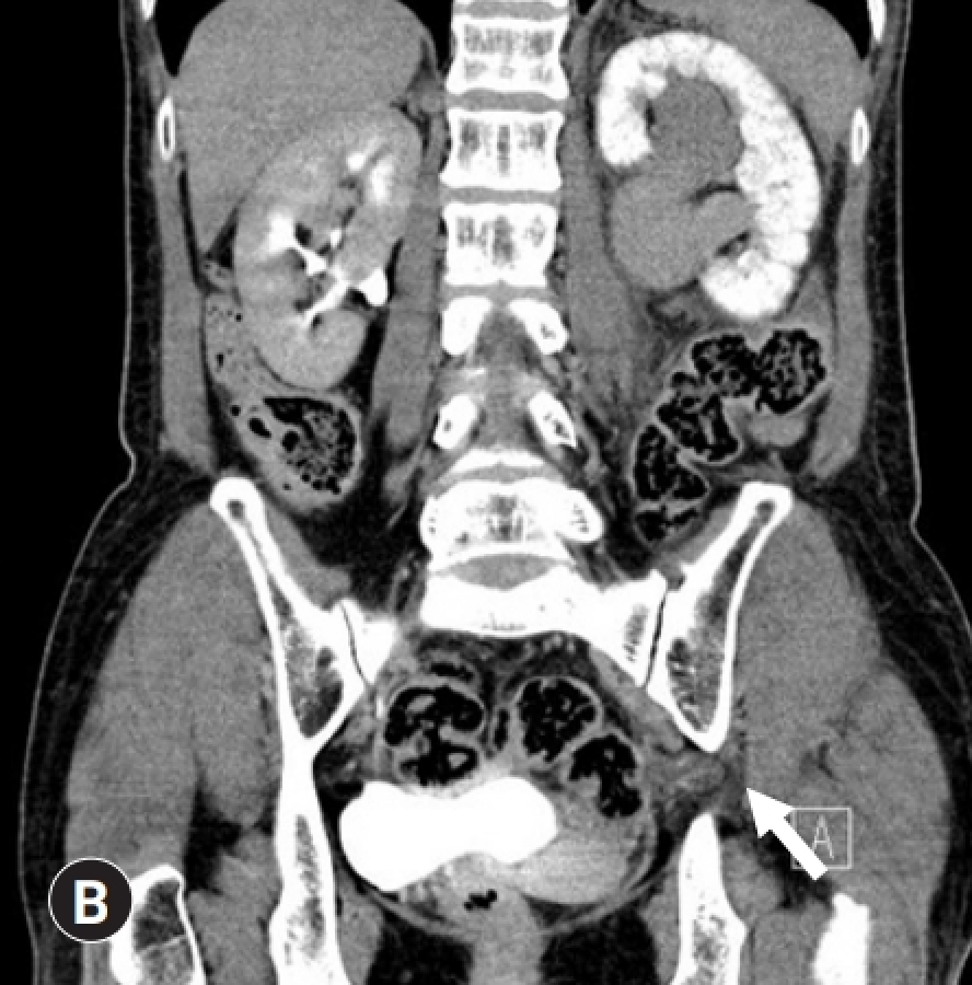 尿管坐骨孔ヘルニア(Ureterosciatic hernia)
case5]
