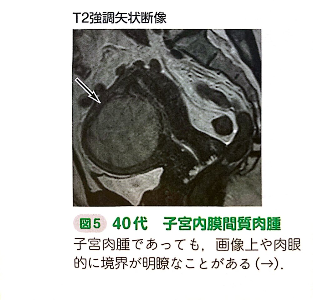 ESS
子宮内膜間質肉腫
endometrial stromal sarcoma
case16