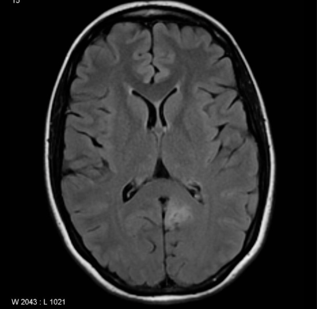 FCD 
focal cortical dysplasia
限局性皮質異形成
case7