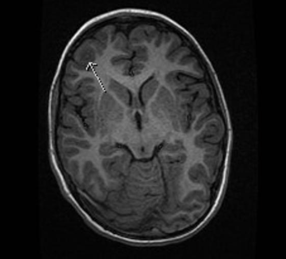 FCD 
focal cortical dysplasia
限局性皮質異形成